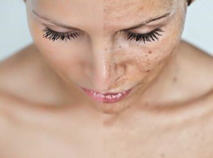 Claves para tratar las manchas en el rostro