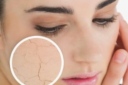 ¿Piel seca o deshidratada? ¡No es lo mismo!